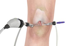 Diagnostic Arthroscopy